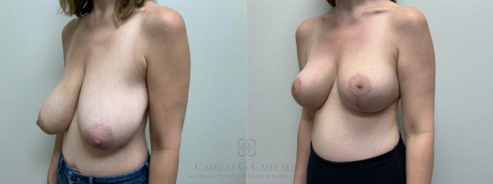 Before & After Breast Reduction Case 608 Right Oblique View in Houston, TX