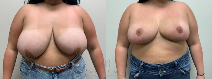 Before & After Breast Reduction Case 609 Front View in Houston, TX