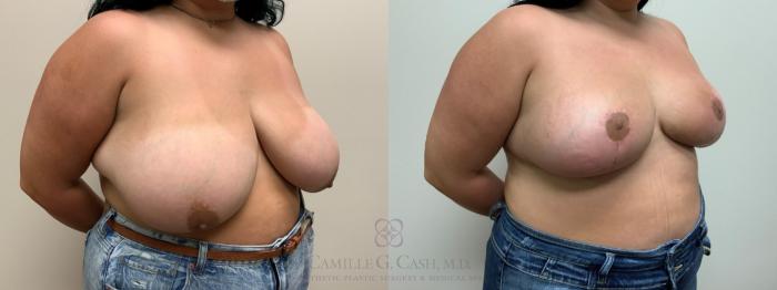 Before & After Breast Reduction Case 609 Left Oblique View in Houston, TX