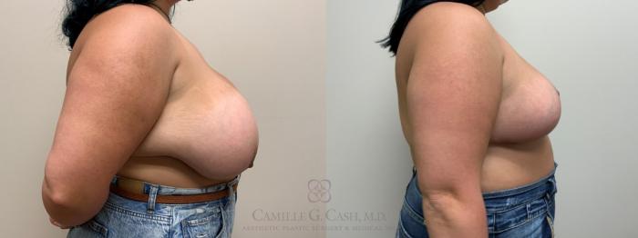 Before & After Breast Reduction Case 609 Left Side View in Houston, TX
