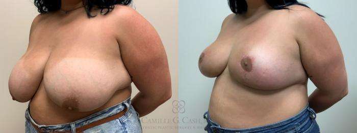 Before & After Breast Reduction Case 609 Right Oblique View in Houston, TX