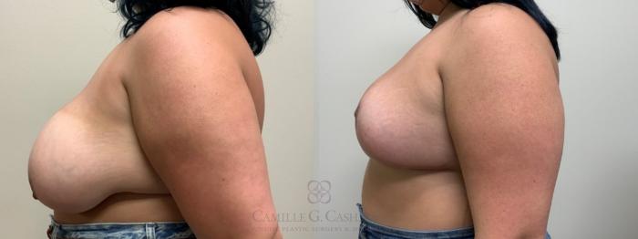 Before & After Breast Reduction Case 609 Right Side View in Houston, TX