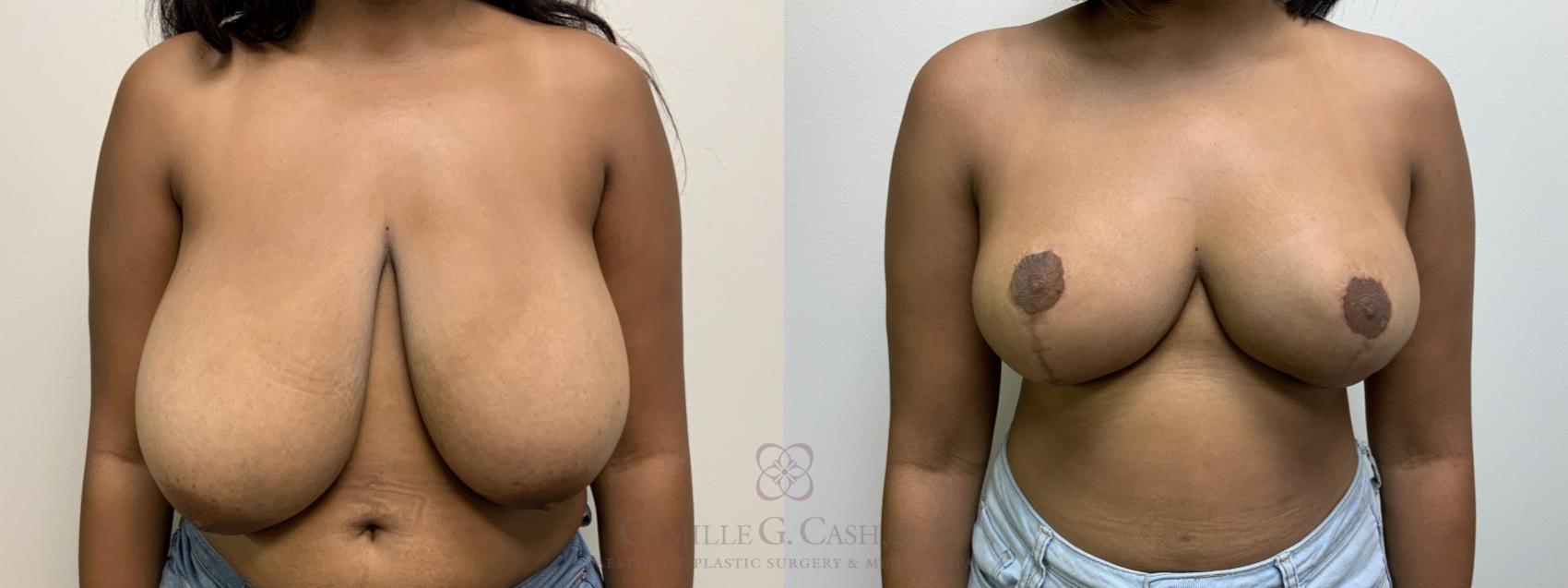 Before & After Breast Reduction Case 613 Front View in Houston, TX