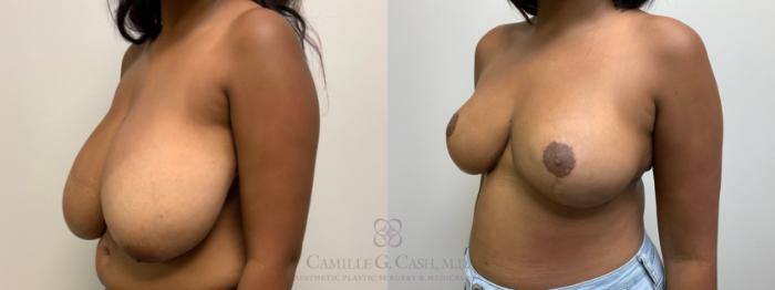 Before & After Breast Reduction Case 613 Left Oblique View in Houston, TX