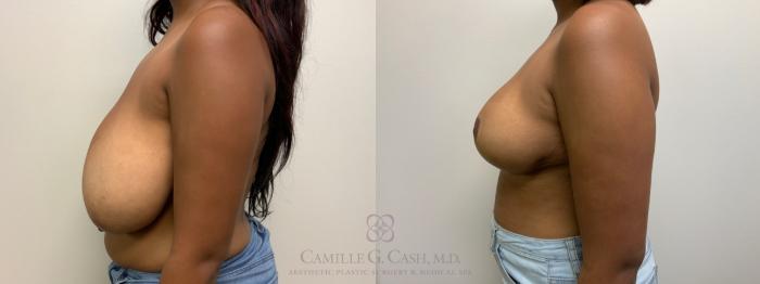 Before & After Breast Reduction Case 613 Left Side View in Houston, TX