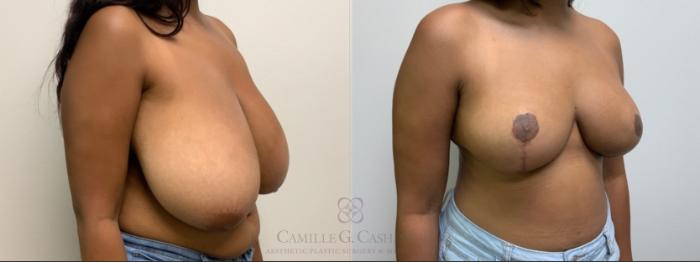 Before & After Breast Reduction Case 613 right ob View in Houston, TX