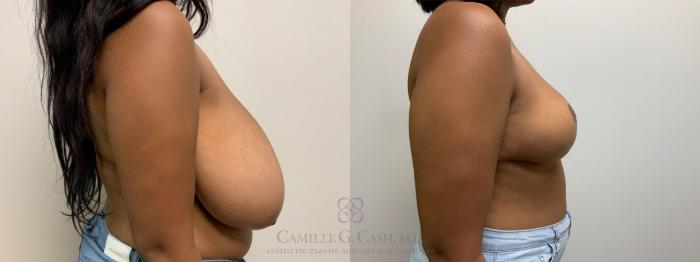 Before & After Breast Reduction Case 613 Right Side View in Houston, TX