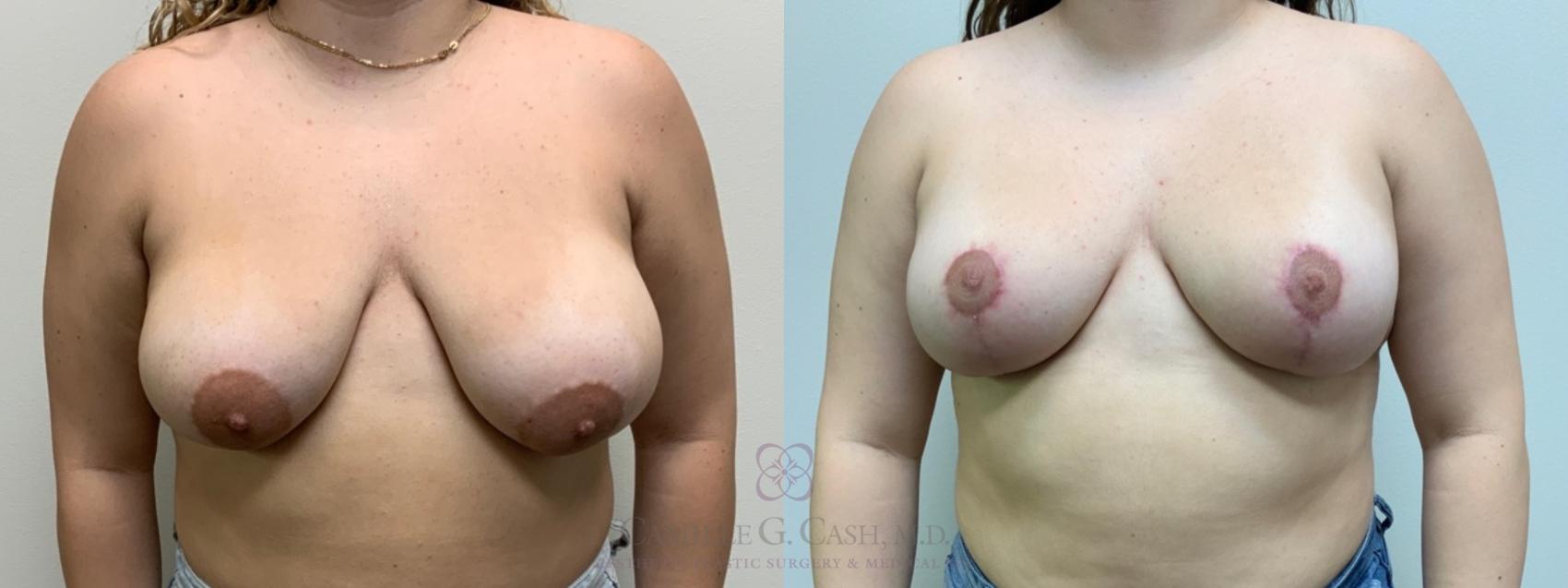 Before & After Breast Reduction Case 614 Front View in Houston, TX