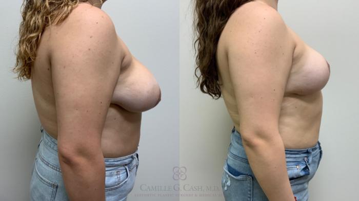 Before & After Breast Reduction Case 614 Left Side View in Houston, TX
