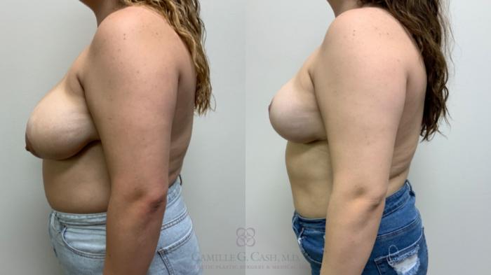 Before & After Breast Reduction Case 614 Right Oblique View in Houston, TX