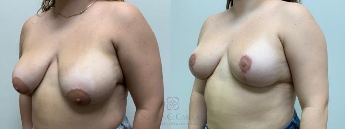 Before & After Breast Reduction Case 614 Right Side View in Houston, TX