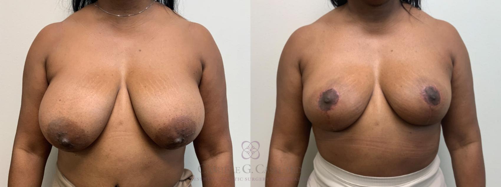 Before & After Breast Reduction Case 627 Front View in Houston, TX