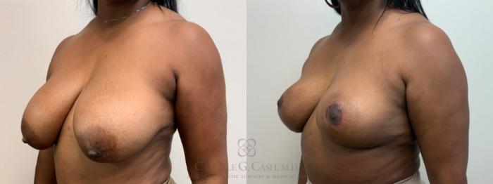 Before & After Breast Reduction Case 627 Left Oblique View in Houston, TX