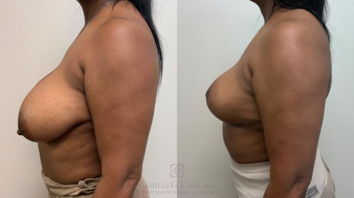 Before & After Breast Reduction Case 627 Left Side View in Houston, TX