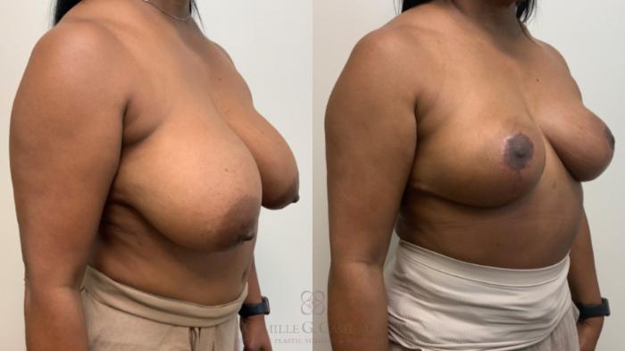 Before & After Breast Reduction Case 627 Right Oblique View in Houston, TX