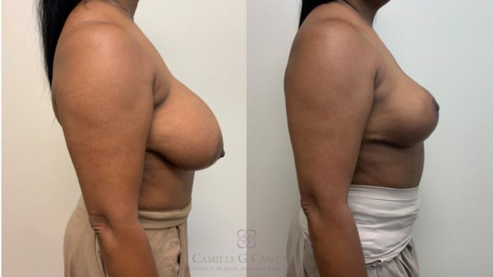 Before & After Breast Reduction Case 627 Right Side View in Houston, TX