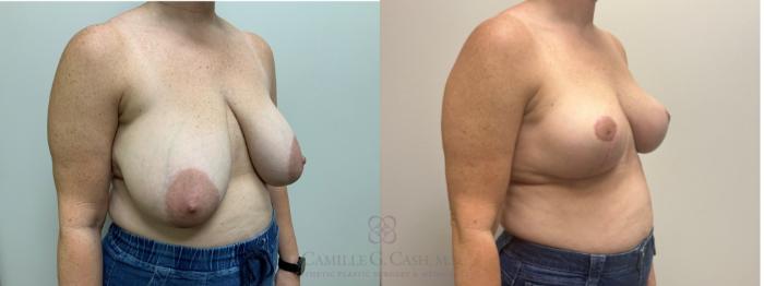 Before & After Breast Reduction Case 628 Left Oblique View in Houston, TX