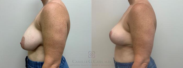 Before & After Breast Reduction Case 628 Left Side View in Houston, TX