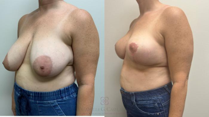 Before & After Breast Reduction Case 628 Right Oblique View in Houston, TX