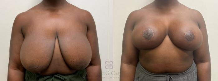 Before & After Breast Reduction Case 629 Front View in Houston, TX