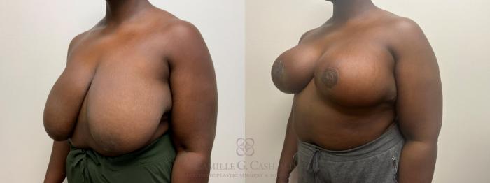 Before & After Breast Reduction Case 629 Left Oblique View in Houston, TX