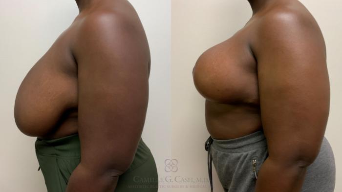 Before & After Breast Reduction Case 629 Left Side View in Houston, TX