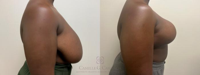 Before & After Breast Reduction Case 629 Right Side View in Houston, TX
