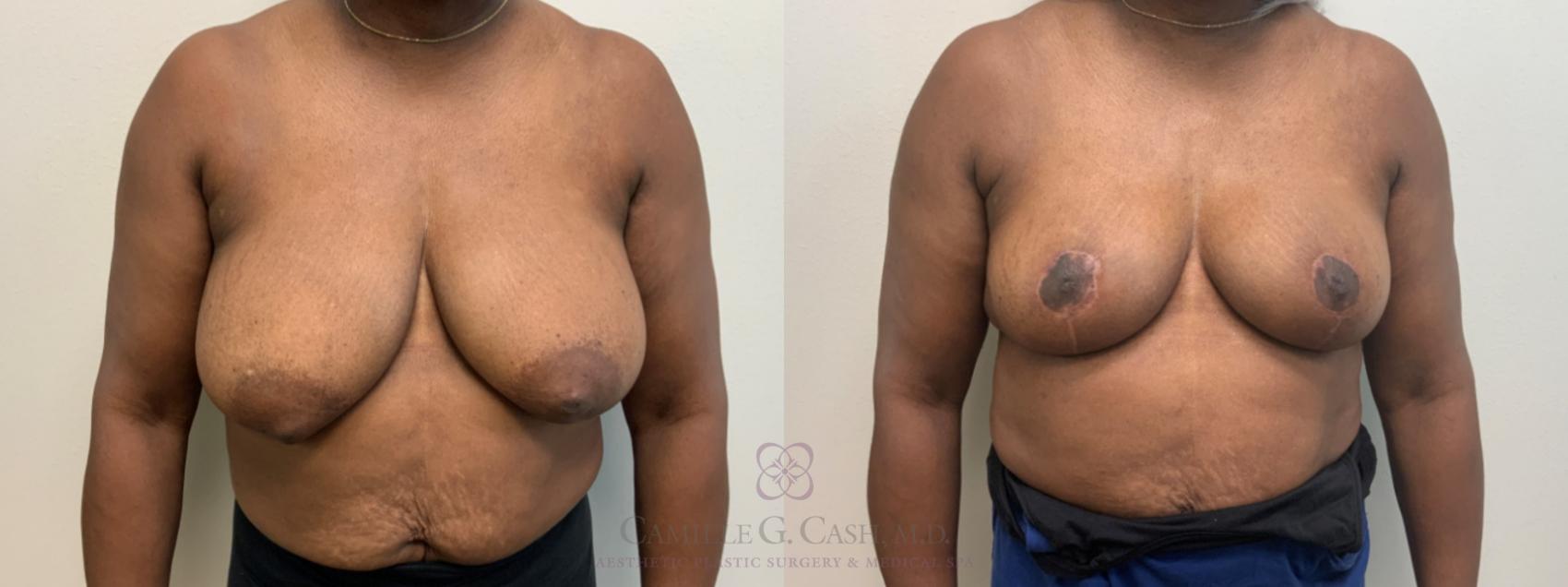 Before & After Breast Reduction Case 630 Front View in Houston, TX