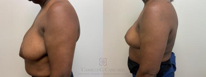 Before & After Breast Reduction Case 630 Left Side View in Houston, TX