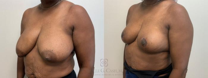 Before & After Breast Reduction Case 630 Right Oblique View in Houston, TX