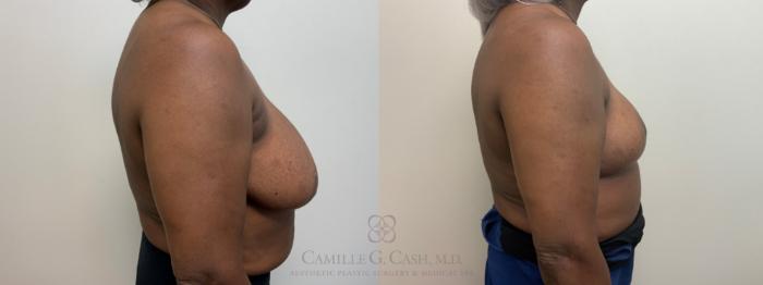 Before & After Breast Reduction Case 630 Right Side View in Houston, TX