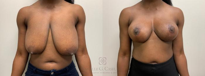 Before & After Breast Reduction Case 634 Front View in Houston, TX