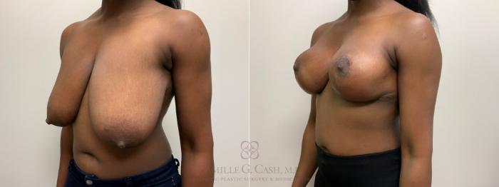 Before & After Breast Reduction Case 634 Left Oblique View in Houston, TX