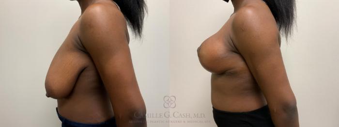 Before & After Breast Reduction Case 634 Left Side View in Houston, TX