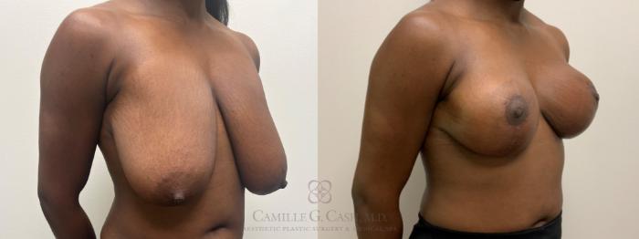 Before & After Breast Reduction Case 634 Right Oblique View in Houston, TX
