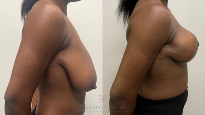 Before & After Breast Reduction Case 634 Right Side View in Houston, TX