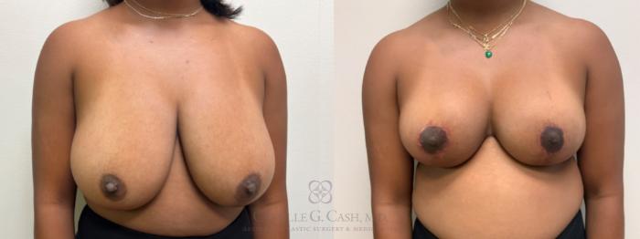 Before & After Breast Reduction Case 637 6 View in Houston, TX