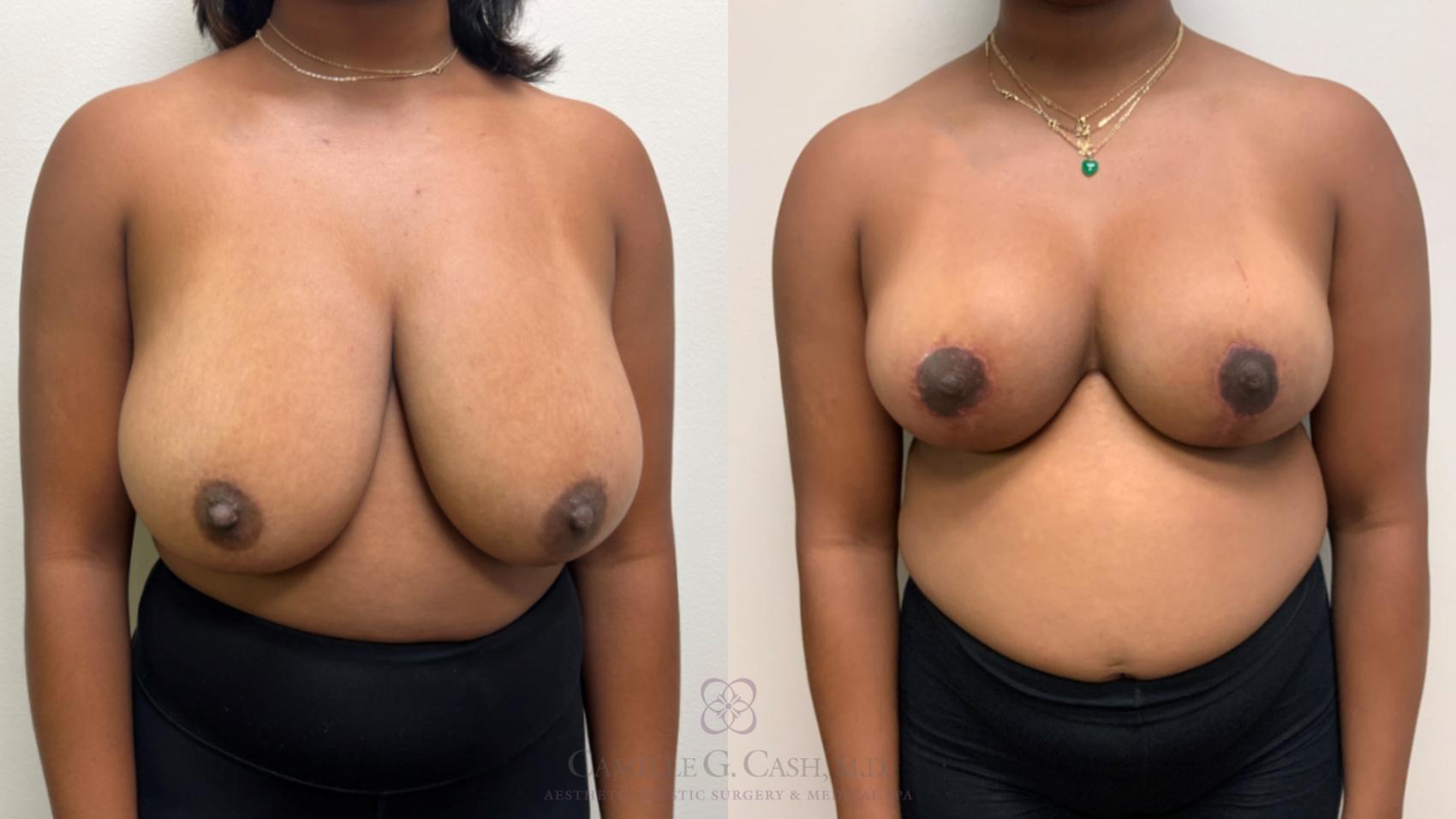 Before & After Breast Reduction Case 637 Front View in Houston, TX
