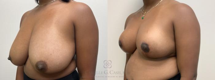 Before & After Breast Reduction Case 637 Left Oblique View in Houston, TX