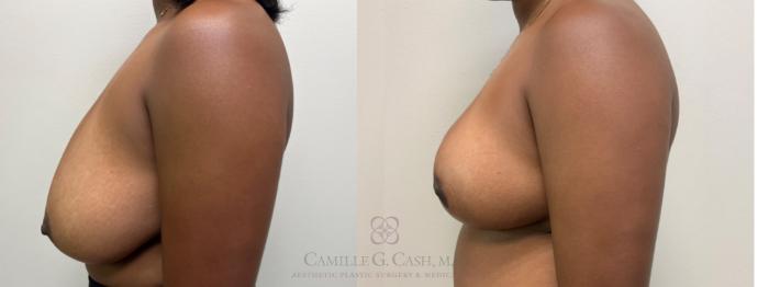Before & After Breast Reduction Case 637 Left Side View in Houston, TX