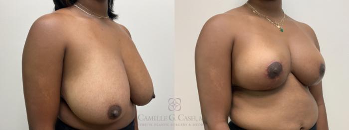 Before & After Breast Reduction Case 637 Right Oblique View in Houston, TX