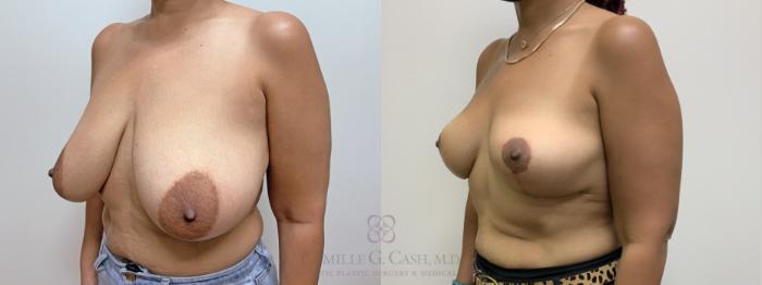 Before & After Breast Reduction Case 640 Left Oblique View in Houston, TX
