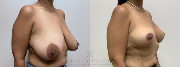 Before & After Breast Reduction Case 640 Right Oblique View in Houston, TX