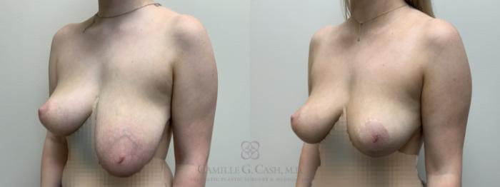 Before & After Breast Reduction Case 643 Left Oblique View in Houston, TX