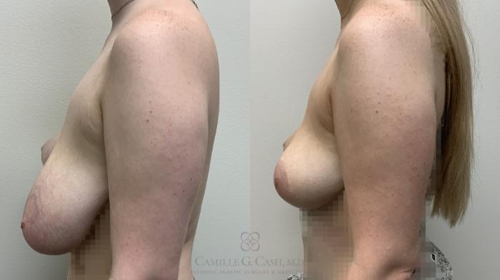Before & After Breast Reduction Case 643 Left Side View in Houston, TX