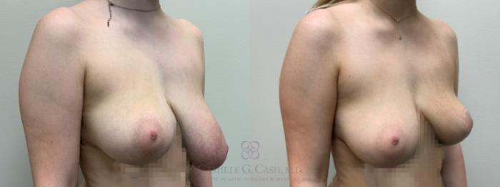 Before & After Breast Reduction Case 643 Right Oblique View in Houston, TX