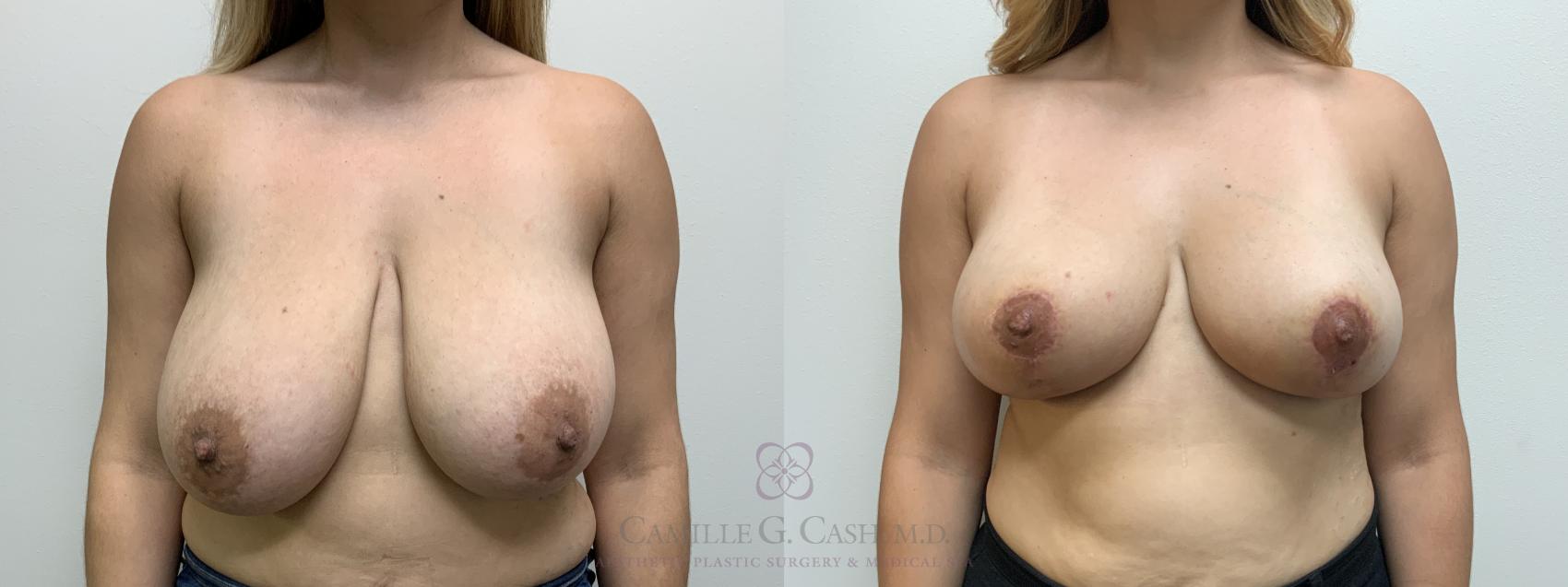 Before & After Breast Reduction Case 645 Front View in Houston, TX