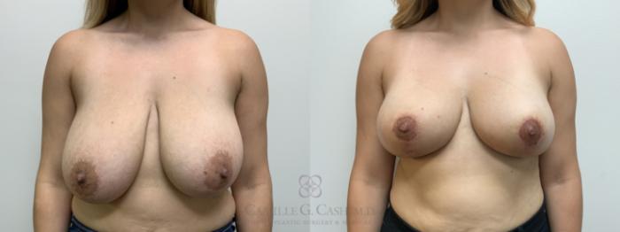 Before & After Breast Reduction Case 645 Front View in Houston, TX