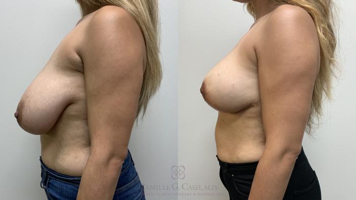 Before & After Breast Reduction Case 645 Left Side View in Houston, TX