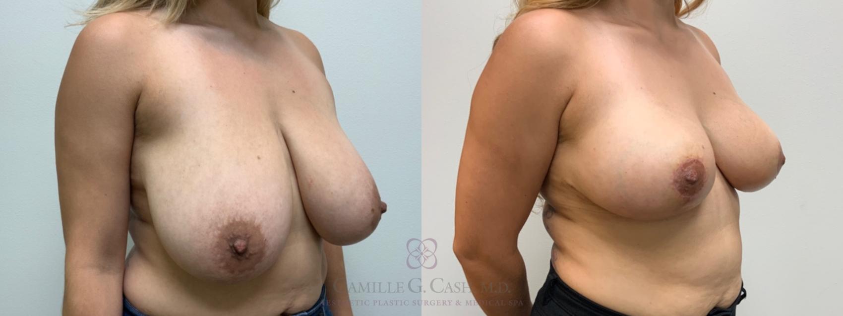 Before & After Breast Reduction Case 645 Right Oblique View in Houston, TX